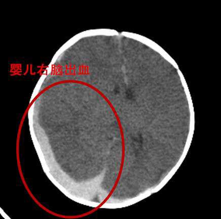 4个月婴儿突然大量吐奶，原因、应对与预防