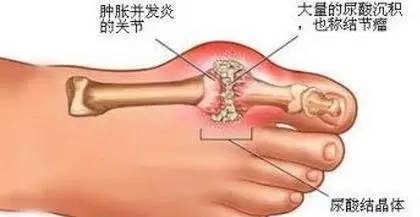 痛风一个月发作一次，原因、预防与治疗方法