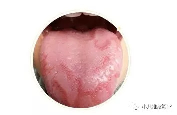 9个月宝宝舌苔咖啡色，原因、影响及应对措施